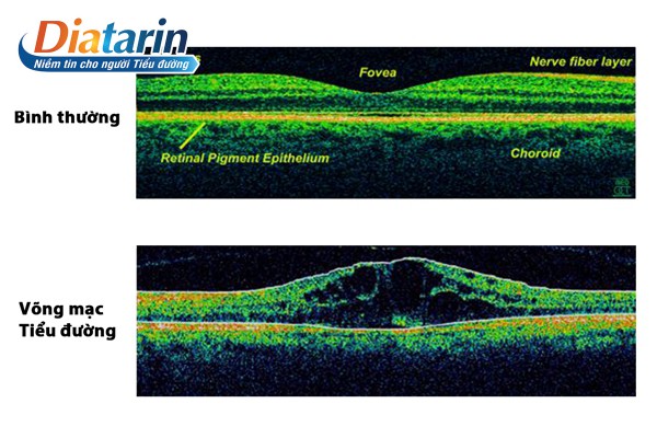 Hình ảnh Chụp cắt lớp mạch lạc quang học (OCT)