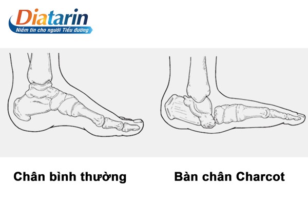 Hiện tượng bàn chân Charcot gặp ở rất nhiều bệnh nhân đái tháo đường