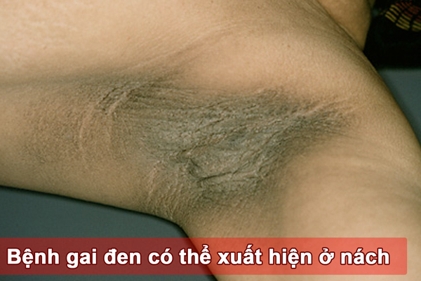 Triệu chứng Gai Đen có thể xuất hiện ở nách hay những vùng da có vết gấp