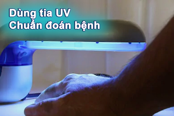 Chuẩn đoán bệnh bạch biến bằng tia UV